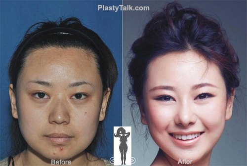 Amazing facts about Rhinoplasty in Singapore